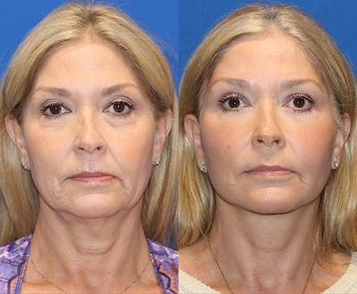 Patient 71700612 | Vertical Restore® / Facial Rejuvenation Before & After Photos | Carmel Valley Plastic Surgery Restylane Lyft, Laser Peel, Skin Care Guide, Fat Transfer, Lip Augmentation, Facial Plastic Surgery, Facial Rejuvenation, Brow Lift, Facial Plastic