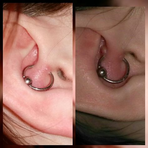 Hello!  So my ear isn't completely healed, but you can see a huge difference from when it was infected with a gross bump (on the right) versus now (about 3 treatments in).  I'll tell ya what I did!  Pure apple cider vinegar in a Q tip and rub onto the enter and exit holes of piercing! Even clean the piercing with the acv! Piercing Bump, Q Tip, Body Mods, Nose Piercing, Rings Bracelets, Cider Vinegar, Earrings Rings, Apple Cider Vinegar, Nostril Hoop Ring