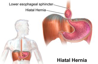 Hiatal Hernias are the Hidden Cause of Numerous Health Problems Hiatal Hernias, Causes Of Migraine Headaches, Thoracic Cavity, Chronic Cough, The Digestive System, Reflux Disease, Migraine Headaches, Medical Knowledge, Chest Pain