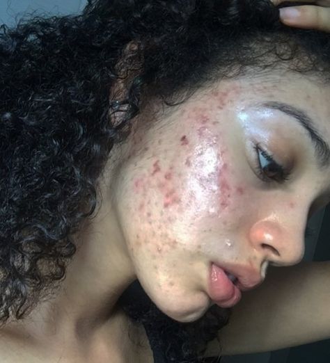 Model 'clears up severe acne in a week with this natural skincare routine' | Metro News Acne Skincare Routine, Natural Acne Remedies, Severe Acne, Natural Skin Care Routine, Acne Remedies, Natural Beauty Tips, Skincare Tips, Acne Skin, Better Skin