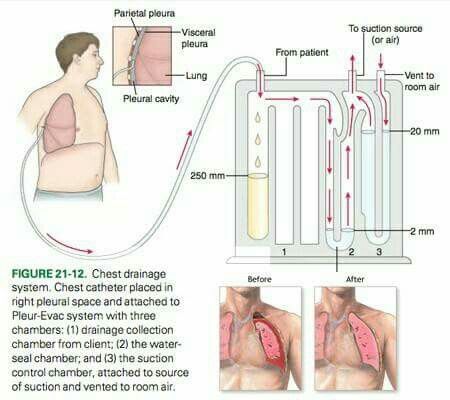 Chest Tubes Nursing Information, Chest Tube, Nursing Board, Critical Care Nursing, Homemade 3d Printer, Nurse Rock, Respiratory Therapy, Nursing School Studying, Nursing School Tips