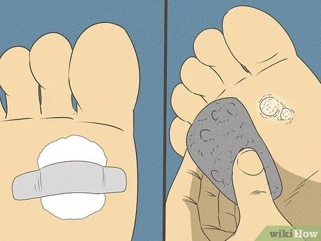 3 Ways to Get Rid of Calluses - wikiHow Diy Callus Remover, Get Rid Of Corns On Feet Fast, Remove Callous From Foot, How To Remove Calluses From Foot, Calloused Feet Remedy, How To Get Rid Of Calluses On Feet Fast, Calluses On Feet Remedies, Callus Remover Diy, Foot Soak For Calluses