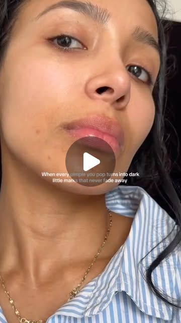 Dr. David Kim on Instagram: "Skincare recommendations for hyperpigmentation from acne scars ✨ Acne is all about prevention so try to stick to this routine even if you don’t have acne so you can treat hyperpigmentation and keep acne under control. 👨🏻‍⚕️ 

✅ Benzoyl Peroxide. Use 4% BP wash every day to keep your acne under control. @panoxyl 

✅ Azelaic acid 15%. Azelaic acid helps treat acne and hyperpigmentation, and is pregnancy safe! Use this every morning. 

✅ Tinted SPF. Use tinted SPF to keep your skin protected from UV rays and visible light to soften and prevent hyperpigmentation. @mylightsaver 

✅ Tretinoin 0.025-0.05%. Tretinoin is the ultimate MVP. Use tretinoin 2-3x per week at night to improve hyperpigmentation, acne, acne scarring, and skin texture. Altreno is my favorite. Skincare Recommendations, Treat Hyperpigmentation, Instagram Skincare, Treating Hyperpigmentation, Acne Scarring, Tinted Spf, Treat Acne, Azelaic Acid, Benzoyl Peroxide