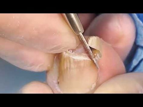 nail fungal infection toenails removal Ingrown Nail Removal, Toenail Pain, Pedicure Tutorial, Fungal Infection Remedies, Toenail Removal, Toenail Fungal Infection, Nail Remedies, Nail Removal, Nail Fungus Remedy