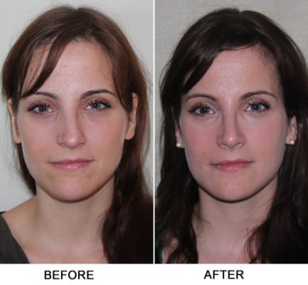 septoplasty turbinate reduction - Yahoo Search Results Broken Nose Surgery, Kpop Plastic Surgery, Jaw Reduction Surgery, Ethnic Rhinoplasty, Lipo Before And After, Plastic Surgery Fail, Rhinoplasty Nose Jobs, Plastic Surgery Gone Wrong, Rhinoplasty Before And After