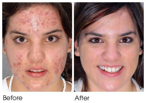 Before and after acne female Tretinoin Cream, Moderate Acne, Acne Overnight, Acne Vulgaris, Natural Acne, Severe Acne, Acne Problem, Acne Scar Removal, Acne Breakout