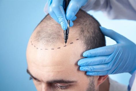 DHI Hair Transplant in Turkey - Price & Special Packages Hair Transplant Cost, Hair Transplant Procedure, Fue Hair Transplant, Hair Transplant Surgery, Best Hair Transplant, Hair Clinic, Skin Clinic, Hair Replacement, Cosmetic Procedures