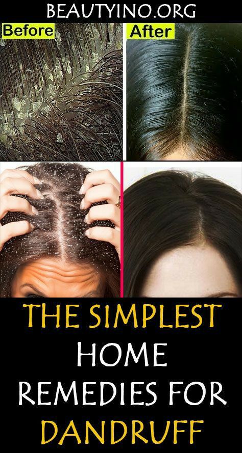 Diy Hair Mask For Dandruff, White Scales, Severe Dandruff, Hair Mask For Dandruff, Dandruff Causes, Dandruff Solutions, Home Remedies For Dandruff, Best Hair Growth Oil, Dandruff Remedy