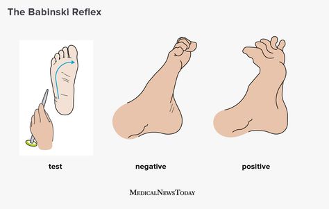 What is the Babinski reflex? Upper Motor Neuron, First Pregnancy Announcements, Hospital Medicine, Primitive Reflexes, Nursing Assessment, Brain Test, Motor Neuron, Medical Knowledge, Central Nervous System