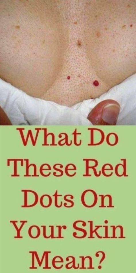 WHAT DO THESE RED DOTS ON YOUR SKIN MEAN? Health For Women, What Is Health, Healthy Woman, Health Women, Mole Removal, Health Signs, Women Health Care, Health Tips For Women, Beauty Center