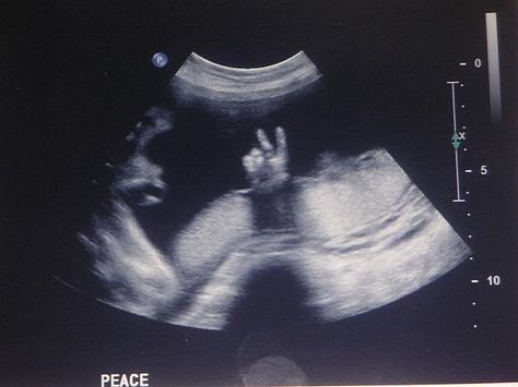 Peace on Earth... Boy Ultrasound, Funny Baby Boy, Baby Ultrasound, Ultrasound Pictures, Ultrasound, Nursery Rhymes, Funny Babies, Beautiful Photography, Baby Pictures