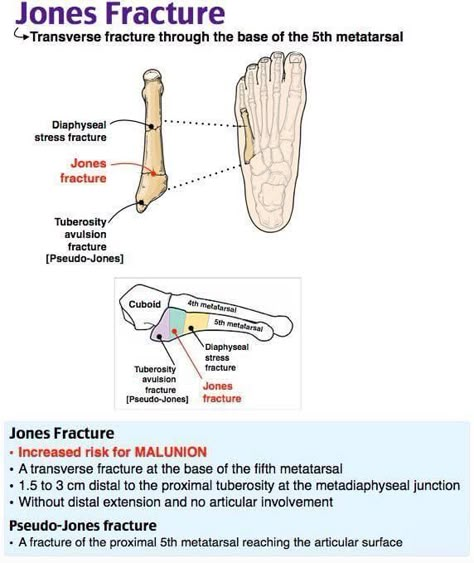 Jones Fracture, Orthopedic Nursing, Medical Biology, Physician Assistant School, Radiologic Technology, General Medicine, Radiology Student, Medical Images, Radiology Technician