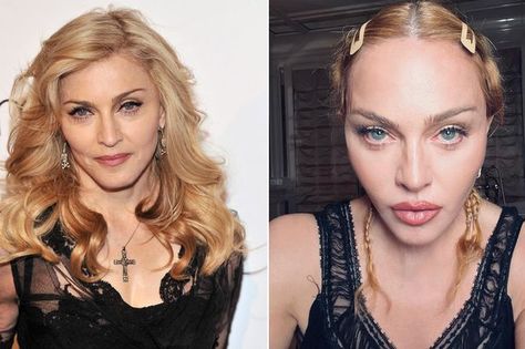 Madonna Now, Bacterial Infection, Take A Break, Plastic Surgery, Then And Now, Madonna, Celebrity News, And Now, Surgery