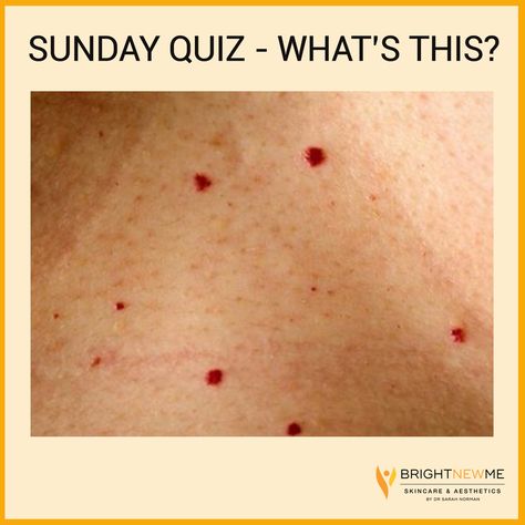 🔎Sunday Quiz. Do you know what these are? ⁠ 👉 Campbell de Morgan, AKA Cherry Angiomas. Just a proliferation of blood vessels. Absolutely harmless. More common with age. The most common type of angioma.⁠ ⁠ If they cause cosmetic concern they can be treated easily, without scarring - https://www.brightnewme.co.uk/skin-lesions-warts-moles-and-skin-tags/ #BrightNewMeSkincare #CherryAnigomas #CampbellDeMorgan #CheshireAesthetics #ManchesterSkinClinic #Skincare Facial Mole, Thread Veins, Skin Lesions, Red Moles, Skin Tags, Scarring, Skin Clinic, Improve Sleep Quality, Patient Experience