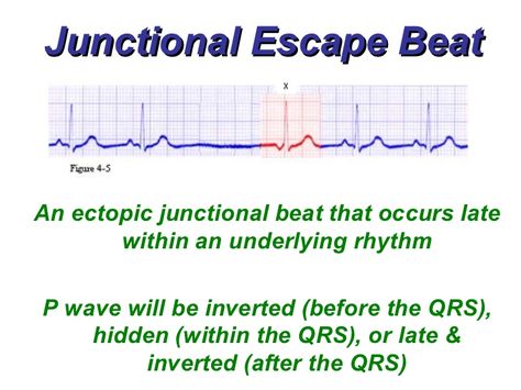 Junctional Escape Beat An ectopic junctional beat that occurs late within an underlying rhythm P wave will be inverted (be... Junctional Rhythm, Endocrine System Nursing, Med Notes, Cranial Nerves Mnemonic, Lab Assistant, Ekg Interpretation, Paramedic School, P Wave, Pharmacology Nursing