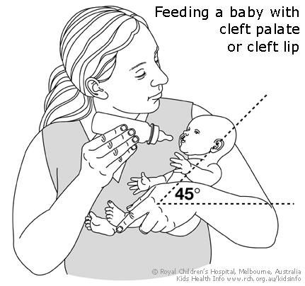 Dysphagia Therapy, Cleft Lip And Palate, Feeding Therapy, Cleft Palate, Infant Feeding, Cleft Lip, Oral Motor, Feeding Baby, Feeding Toddlers