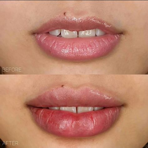 Bottom Lip Filler, Lip Filler Technique, Best Laser Hair Removal, Lip Augmentation, Lip Filler, Lip Enhancement, Bottom Lip, Lip Shapes, Cosmetic Procedures