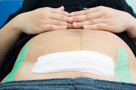 6 Warning Signs To Look For After C-Section Surgery Operasi Caesar, Delayed Cord Clamping, C Section Scars, Birth Partner, Emergency C Section, Cardiac Disease, Abdominal Surgery, Feeding Pillow, Prenatal Care