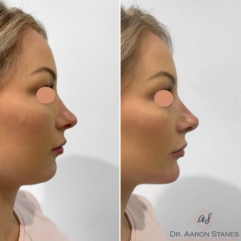 Side Profile Enhancement Purpose: Improve the definition, shape and balance of your side profile. How it works: Injections using dermal filler. Time it takes: 10-20 minutes Downtime: None Maintenance: Revisit 12-24 months on average Discomfort: Minimal, numbing options available Price: Please see website for our current pricing Suitability: 18+. Not suitable if you’re pregnant or breastfeeding Caution: Must be performed by an experienced, registered practitioner Profile Balancing Fillers, Small Chin Side Profile, How To Fix Side Profile, Face From The Side, Face Symmetry, Fuller Lips Naturally, Chin Filler, Rhinoplasty Nose Jobs, Botox Before And After