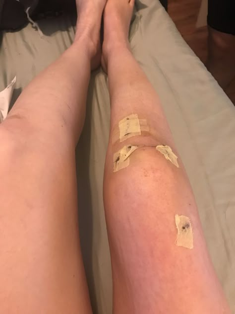 Bandaged Knee Aesthetic, Knee Wound Fake Story, Skinned Knees Aesthetic, Scraped Knees Aesthetic, Injured Leg Snapchat, Knee Injury Snapchat, Knee Aesthetic, Leg Bandage Snapchat, Skinned Knee