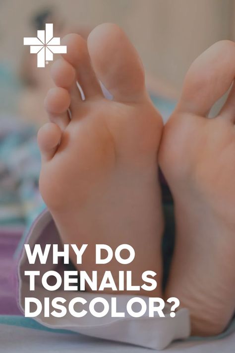 Image of feet with title reading "Why Do Toenails Discolor?" from healthcare system Baylor Scott & White Health Nail Discoloration, Foot Soak, Foot Health, Toe Nails, The Truth, Nail Care, Health Tips, You Think, Nails