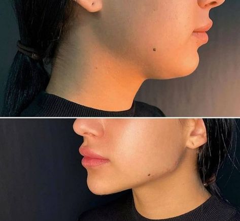 More Defined Jawline, Eye Lift Surgery, Face Plastic Surgery, Nose Surgery Rhinoplasty, Defined Jawline, Lips Inspiration, Face Fillers, Botox Lips, Jaw Surgery