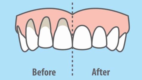 9 Easy Ways to Heal Receding Gums Naturally! - QueenMind Ways To Heal, Gum Recession, Teeth Health, Receding Gums, Oil Pulling, Gum Health, Makijaż Smokey Eye, Teeth Care, Natural Health Remedies