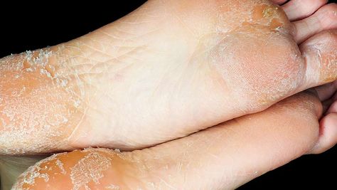 Check out 6 at-home remedies for peeling feet at SheFinds.com. Diy Foot Peel, Peeling Feet Remedy Diy, Peeling Skin On Feet How To Get Rid Of, Dry Cracked Feet Home Remedy, Dry Peeling Feet Remedy, Cracked Feet Remedies, Aloe Vera For Sunburn, Home Remedies For Allergies, Natural Remedies For Migraines