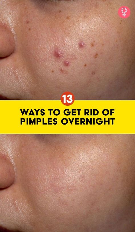 Redness Pimple, Get Rid Of Pimples Overnight, Rid Of Pimples Overnight, Small Pimples, Acne Prevention, Different Types Of Acne, Blind Pimple, Clear Your Skin, Pimples Under The Skin