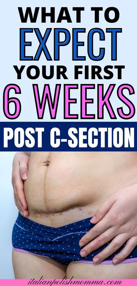 6 Week Post C Section Workout, Post C Section Stretches, C Section Photos, C Section Overhang Belly, 6 Weeks Postpartum, 2 Weeks Postpartum, Post Partum C Section, C Section Belly Before And After, C Section Post Partum