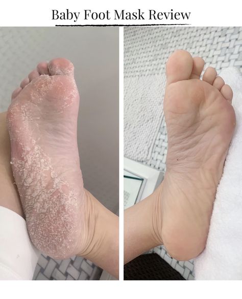 foot peel mask before and after Pedicure Before And After, Aloe Vera For Sunburn, Foot Peel Mask, Home Remedies For Warts, Warts Remedy, Natural Remedies For Migraines, Coconut Oil Hair Mask, Peeling Mask, Dry Skin Remedies