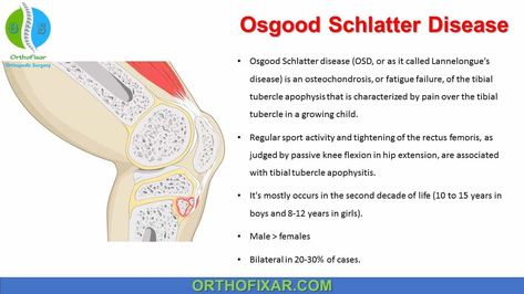 Osgood Schlatter disease (OSD, or as it called Lannelongue's disease) is an osteochondrosis, or fatigue failure, of the tibial tubercle apophysis that is characterized by pain over the tibial tubercle in a growing child. Regular sport activity and tightening of the rectus femoris, as judged by passive knee flexion in hip extension, are associated with tibial tubercle apophysitis. It's mostly occurs in the second decade of life (10 to 15 years in boys and 8-12 years in girls).Male > ... Rectus Femoris, Osgood Schlatter Disease, Knee Meniscus, Gastrocnemius Muscle, Hip Extension, Straight Leg Raise, Growing Child, Med Surg, Orthopedic Surgery