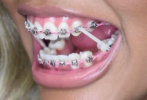 #elastics #powerchain #braces #girlswithbraces Baddie Braces, Powerchain Braces Color, Braces With Rubber Bands, Power Chain Braces, Fashion Braces, Braces Retainer, Braces Colors Ideas, Braces Ideas, Braces Rubber Bands