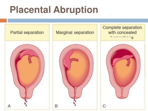 Placental Abruption Placenta Abruption, Placenta Accreta, Blood Infection, Cesarean Section, Premature Birth, Nurse Art, Pregnancy Labor, Relieve Constipation, Bed Rest