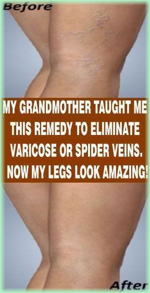 Board name Varicose Vein Remedy, Vein Removal, Fine Cooking, Trening Fitness, Health Tips For Women, Natural Therapy, Natural Remedy, My Grandmother, Diet Keto