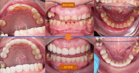 Before1-3/After1-3 - A crowns, bridges and veneers case completed today. CH had severe wear of teeth which was virtually exposing the nerves of the teeth and affecting her smile. Teeth Insecurity, How To Prepare For Wisdom Teeth Removal, Smile While You Still Have Teeth, Stronger Teeth, Wisdom Teeth Meme, The Teeth, Her Smile