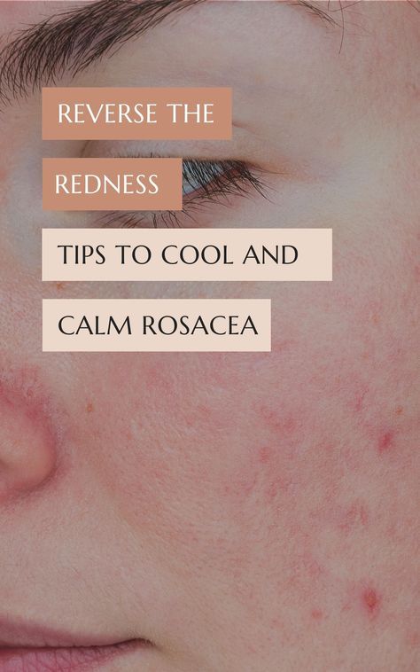 Rosatia Remedies, Redness Remedy, Reduce Face Redness, Redness Reducing Skin Care, Wellness Girlie, Face Redness, Inflammed Skin, Redness On Face, Skin Hacks