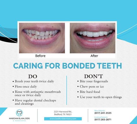 After tooth bonding, your teeth will not need much care beyond your regular oral hygiene habits 🦷⚡ See how dental bonding works and how it can improve your smile at http://bedforddentistry.com/ #bondedteeth #hygienehabits #maeganelamdds #bedford #TX Improve Dental Hygiene, Teeth Bonding, Antiseptic Mouthwash, Dental Bonding, Dental Hygiene, Your Smile, Mouthwash, Oral Hygiene, Improve Yourself