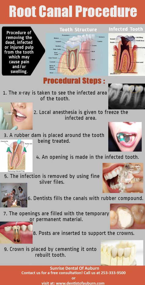 Looking for a dentist in Auburn, WA? Sunrise Dental of Auburn provides all general and cosmetic dental treatments for you. Book an appointment or call our dentist near you today! Root Canal Procedure, Dental Assistant Study Guide, Dental Terminology, Dental Notes, Dental Assistant School, Dental Assistant Study, Dental Nurse, Dental Hygiene Student, Dental Posters