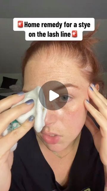 Holistic Remedies | Healthy Tips & Tricks on Instagram: "👀Got an unwelcomed eyelid guest? Ready to show it the exit, pronto? Stye - A painful eyelid bump caused by bacteria in blocked oil glands. Most of the time it will go off by itself but… 🚨If left untreated, styes can cause severe infections, spread to the eye, face, and potentially impair vision. And traditional treatments for styes, like antibiotics, may not address blocked gland issues as effectively as warmth does. 🥚A blend of folklore wisdom and scientific ingenuity, delivering warmth straight to the source of discomfort. 🙅‍♂️How to avoid it in the future? To prevent styes, clean eyelids regularly, avoid touching eyes with dirty hands, remove makeup before bed, and replace eye makeup periodically to minimize bacteria. 🔬Wh Sty In Eye Remedies, Stye Remedies Fast, Get Rid Of Stye, Stye Remedy, Eye Stye Remedies, Soothing Face Mask, Dirty Hands, Eye Infections, The Exit