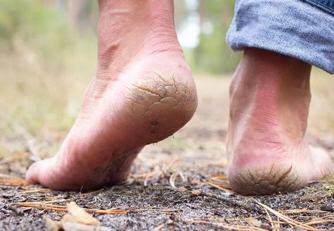 Ugh, there’s nothing like feeling a dry, sandpapery heel graze against your leg. But why do our heels become so rough and dry in the first place? A dermatologist shares how you can take dry heels from dusty and desert-like to satiny-smooth and sensational. Gentle Skin Care Routine, Heal Cracked Heels, Dry Heels, Dry Cracked Heels, Full Body Cleanse, Canker Sore, Gentle Skin Cleanser, Cracked Heels, Cleveland Clinic