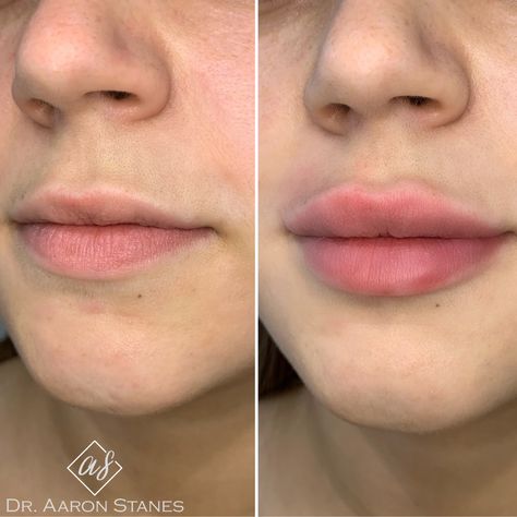 Lip Shapes For Fillers, Madelyn Cline Lips Filler, Good Lip Filler Pictures, Mild Lip Filler, Madelyn Cline Lip Fillers, Top Lip Filler Before And After, Lip Filler Recovery, Lip Filler 2ml, Lip Fillers Before And After 1ml Russian