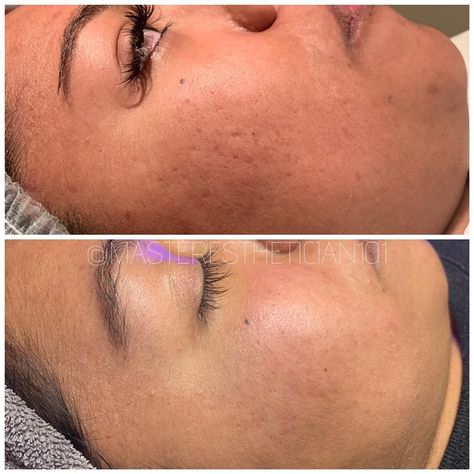 Ruma Aesthetics, Microneedling Before And After, Get Clear Skin Fast, Acne Prone Skin Care Routine, Clear Skin Fast, Get Clear Skin, Acne Prone Skin Care, Aesthetic 2023, Best Hair Transplant