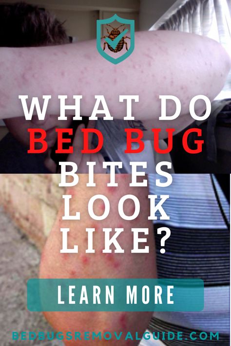 The bites of bed bugs can be mistaken as other household insects because the bites appear like those caused by other insects like fleas, mosquitoes, and lice. However, bed bug bites can be identified when you know the symptoms to look out for. 👉 Learn more. Bed Bug Bites Pictures, Sand Fleas, Get Rid Of Bed Bugs, Kill Bed Bugs, Rid Of Bed Bugs, Bed Bug Bites, Spider Bites, Holistic Diet, Mosquito Bites