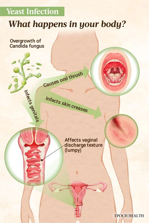 Yeast Infection: Symptoms, Causes, Treatments, and Natural Approaches | The Epoch Times Yeast Infection Symptoms, Candida Albicans, Things Under A Microscope, Medicinal Herbs, Yeast, Health