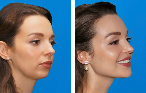 Corrective Jaw Surgery, Face Plastic Surgery, Double Jaw Surgery, Romantic Perfume, Chin Implant, Face Surgery, Facial Bones, Face Lift Surgery, Jaw Surgery