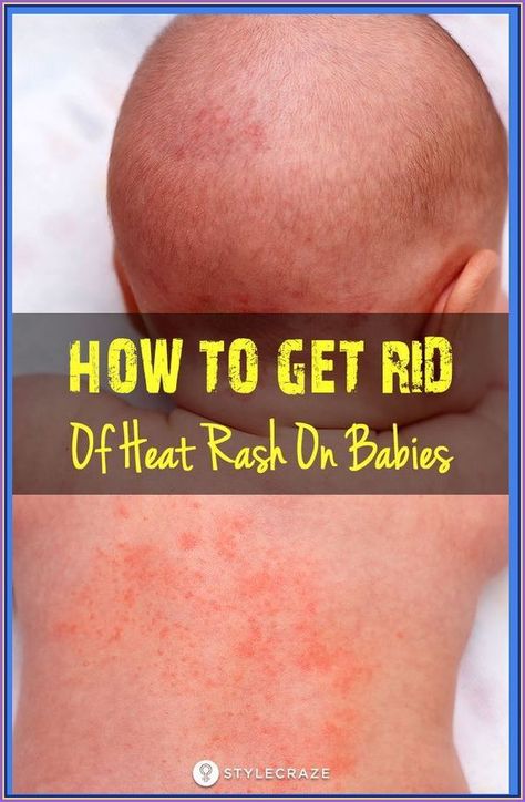 How To Get Rid Of Heat Rash On Babies Heat Bumps, Heat Rash Remedy, Baby Heat Rash, Home Remedies For Rashes, Fever Rash, Rashes Remedies, Heat Rash, Bad Acne, Healthy Advice