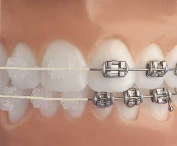 Ceramic Braces, Getting Braces, Teeth Alignment, Clear Braces, Braces Colors, Dental Facts, Dental Braces, Orthodontics Braces, Metal Braces