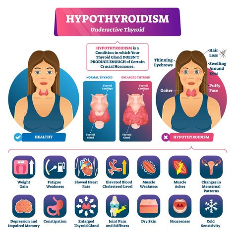 What's hypothyroidism? Hypothyroidism is a condition where a person’s thyroid is underactive, meaning that it does not produce enough of the thyroid hormones. Learn more surprising facts about the thyroid and thyroid diseases. Endocrine System Diseases, Disease Infographic, Enlarged Thyroid, Thyroid Recipes, Overactive Thyroid, Low Thyroid, Hashimotos Disease, Thyroid Gland, Thyroid Hormone