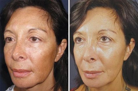 Patient 8348, VI Peel before and after photos Peels For Face, Chemical Face Peel, Vi Peel, Glycolic Acid Peel, Glycolic Peel, Skin Peel, Acne Scarring, Acid Peel, Dry Skin Body